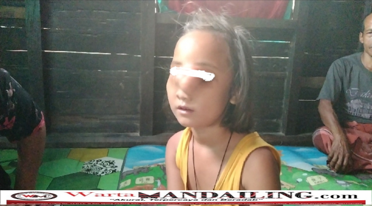 Asifa (8) bocah penderita benjolan di wajah asal kelurahan simangambat butuh bantuan biaya operasi, fhoto : Warta Mandailing.