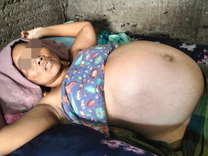 Asnidah Nst (33) menderita perut buncit terbaring lemas di rumah kontrakannya di Desa Gunung Tua Julu, Kecamatan Panyabungan, Kabupaten Mandailing Natal, Kamis (2/5/2024) fhoto : Istimewa.